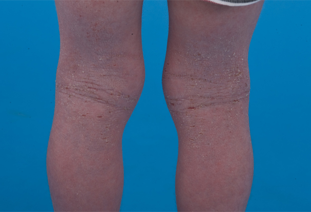 Eczema en el pliegue detrás de la rodilla — rojo, inflamado, de bordes difusos