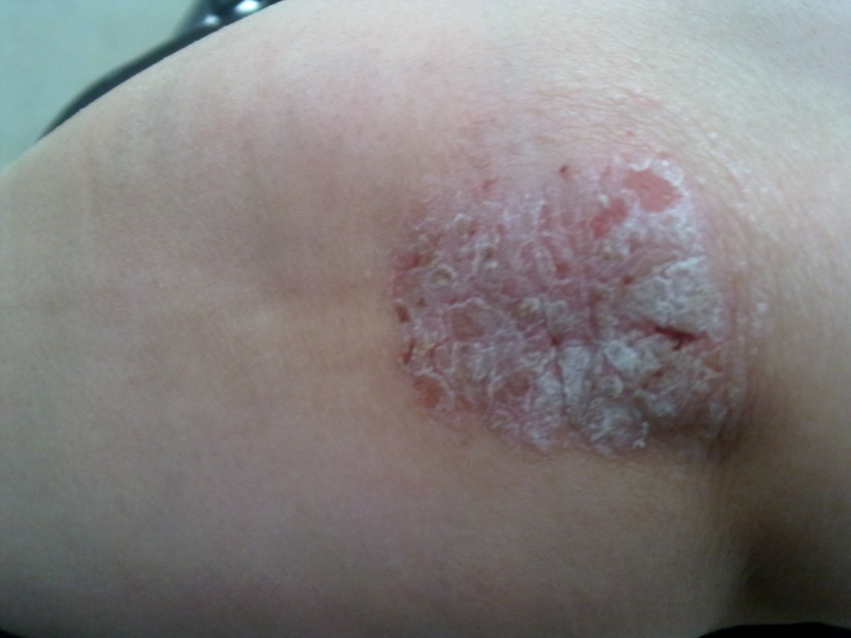 Psoriasis en placas en el codo — escama plateada gruesa con borde nítido