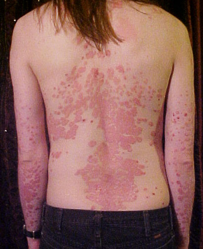 Placa gruesa y plateada de psoriasis en la espalda