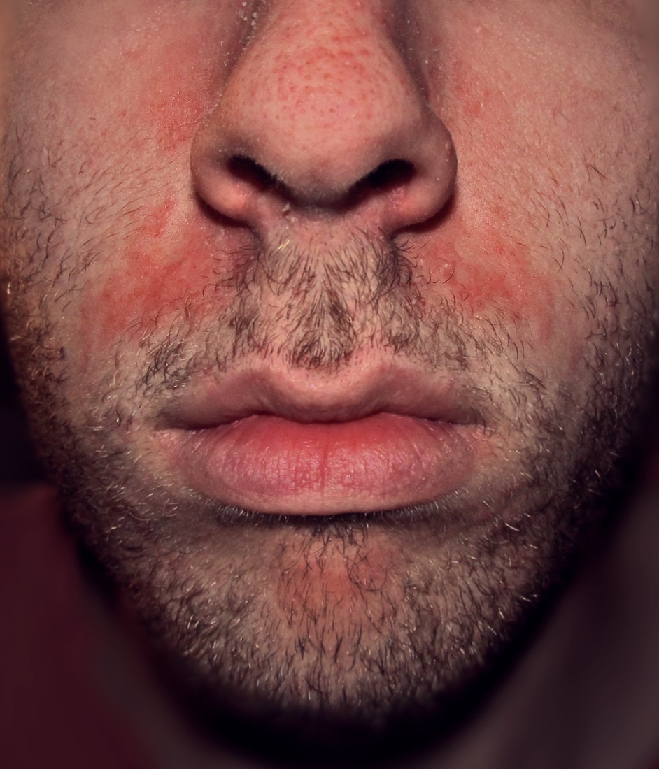 Seborrheic dermatitis on the face — redness and flaking around the nose